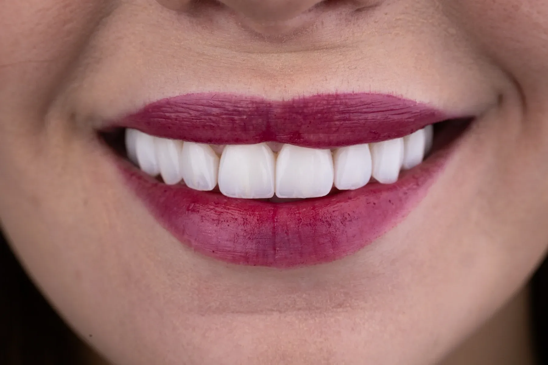 Close-up photograph of a Vivid Smiles patient smiling — frontal arch berry lip