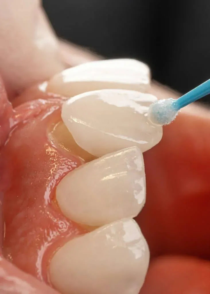 Showing a dental veneer being placed over a prepped tooth