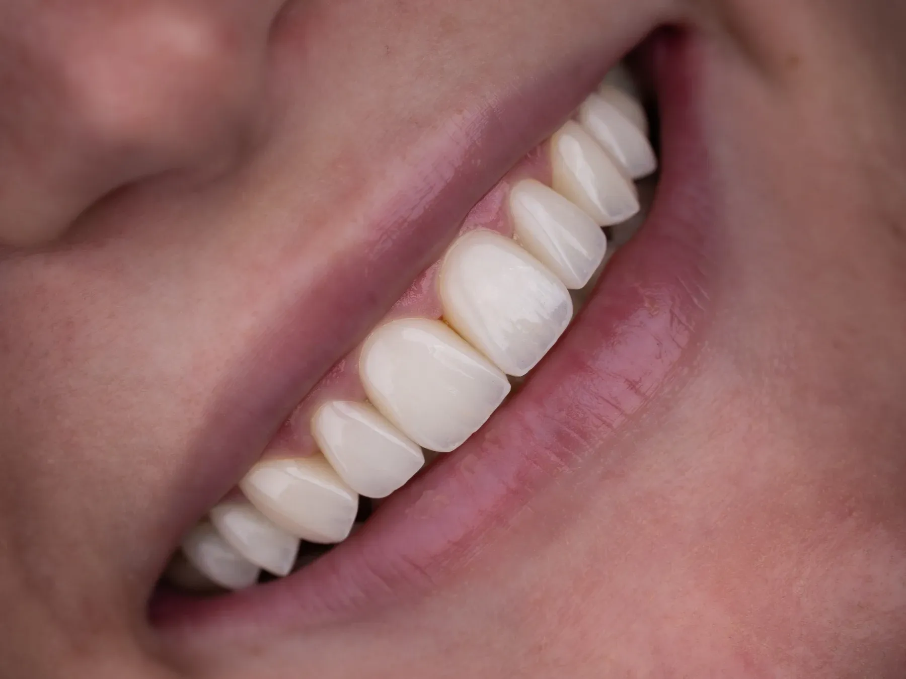 Close-up photograph of a Vivid Smiles patient smiling — three quarter warm ivory