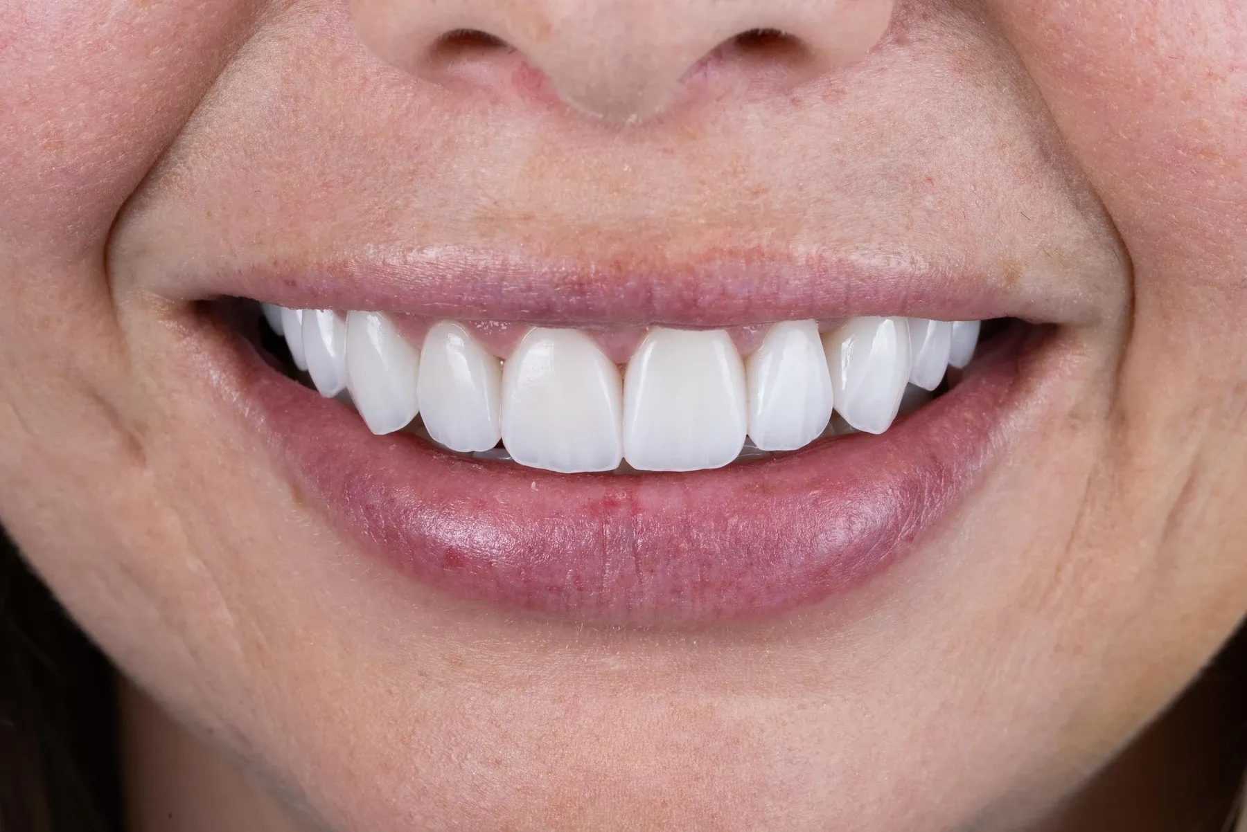 Close-up photograph of a Vivid Smiles patient smiling — frontal arch bare lip