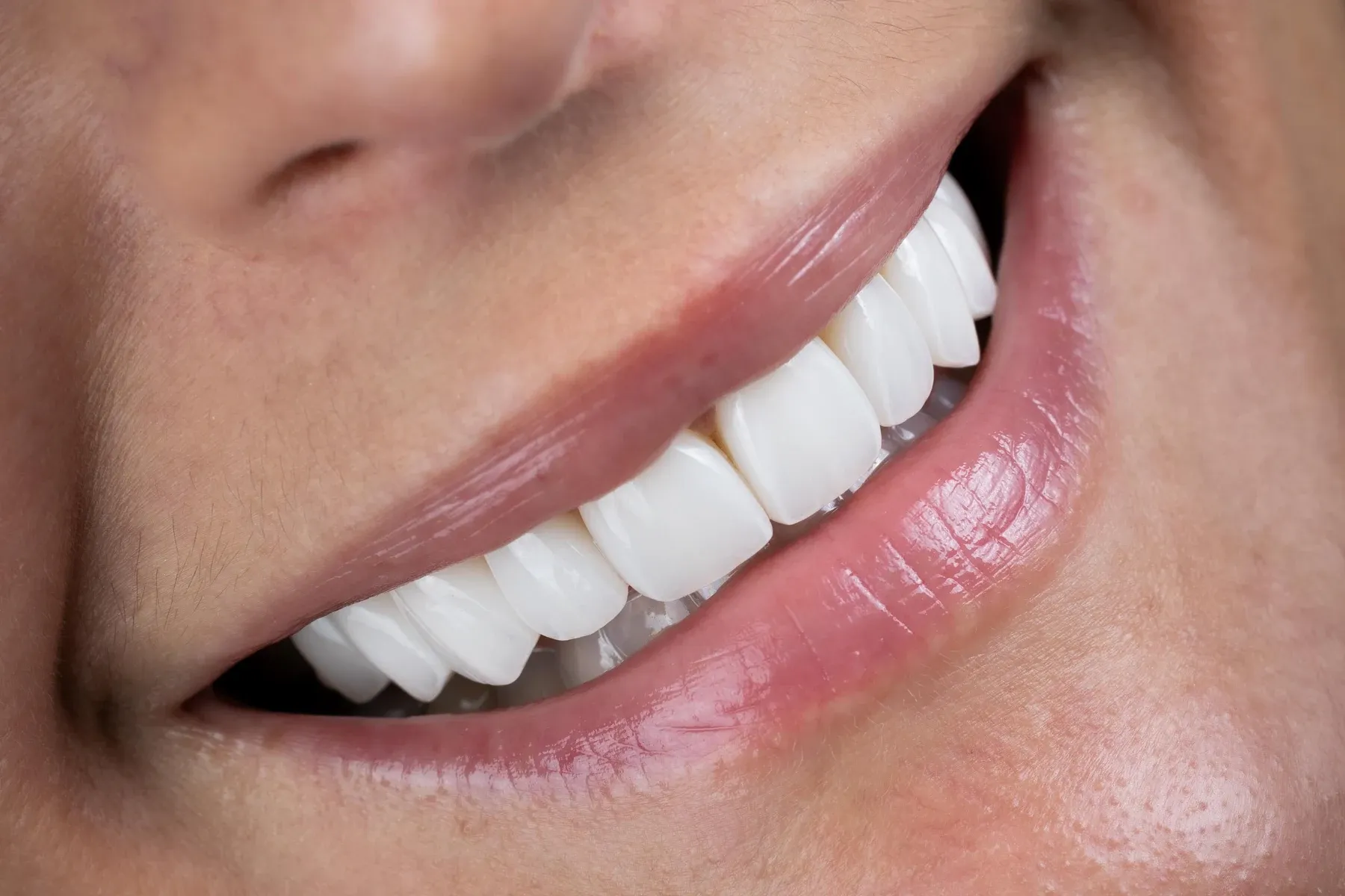 Close-up photograph of a Vivid Smiles patient smiling — three quarter rose lip