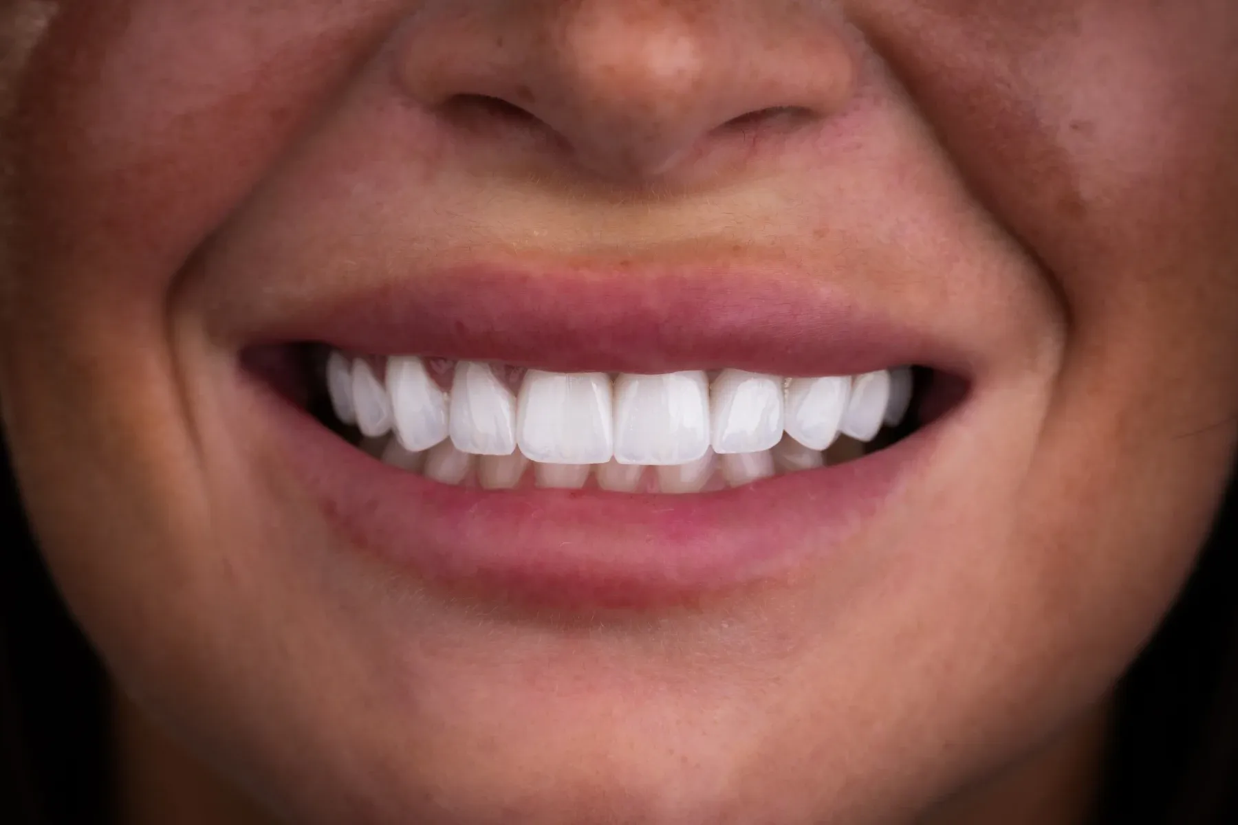 Close-up photograph of a Vivid Smiles patient smiling — frontal arch neutral lip