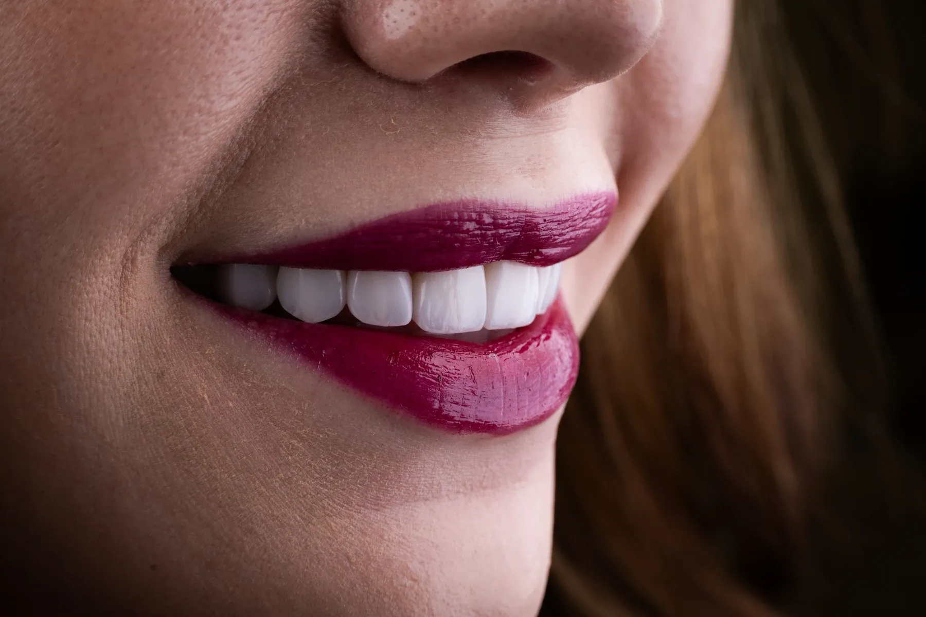 Close-up photograph of a Vivid Smiles patient smiling — three quarter berry lip