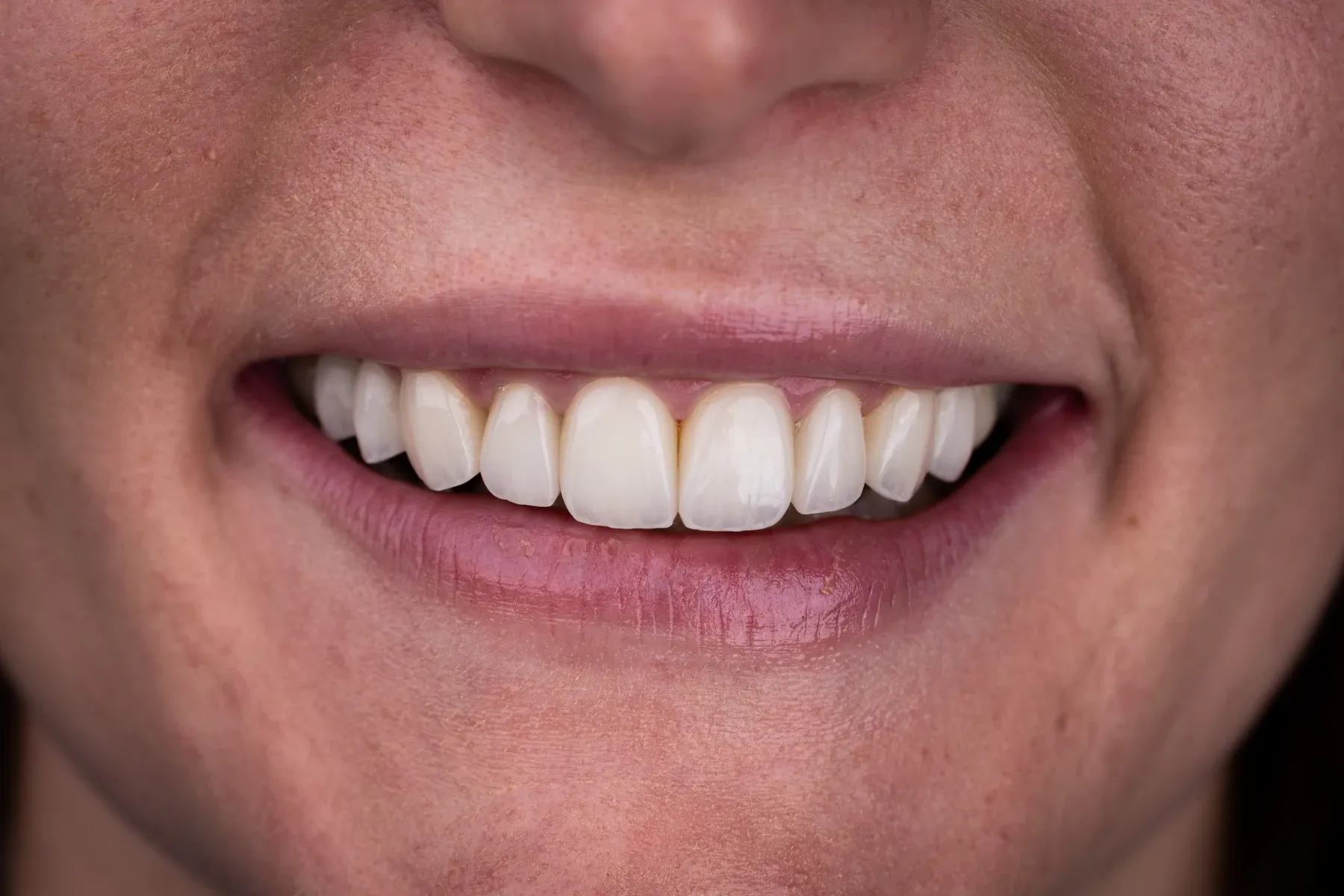 Close-up photograph of a Vivid Smiles patient smiling — frontal arch warm ivory