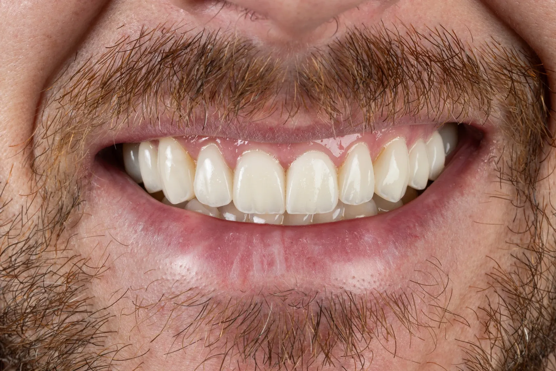 Close-up photograph of a Vivid Smiles patient smiling — bearded natural shade