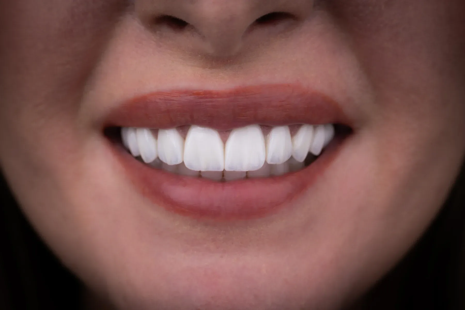 Close-up photograph of a Vivid Smiles patient smiling — frontal arch red lip