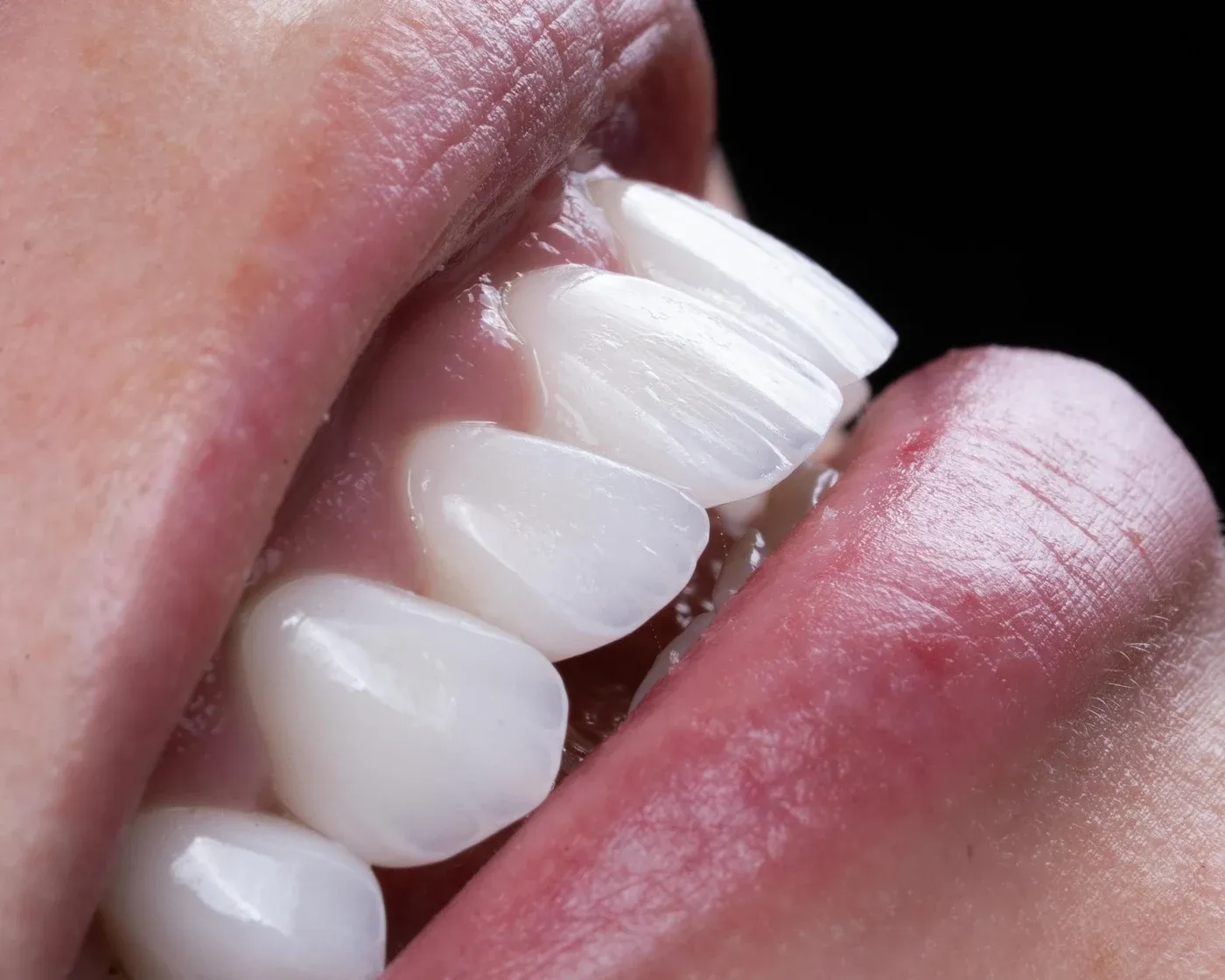Close-up of a finished smile at a three-quarter angle