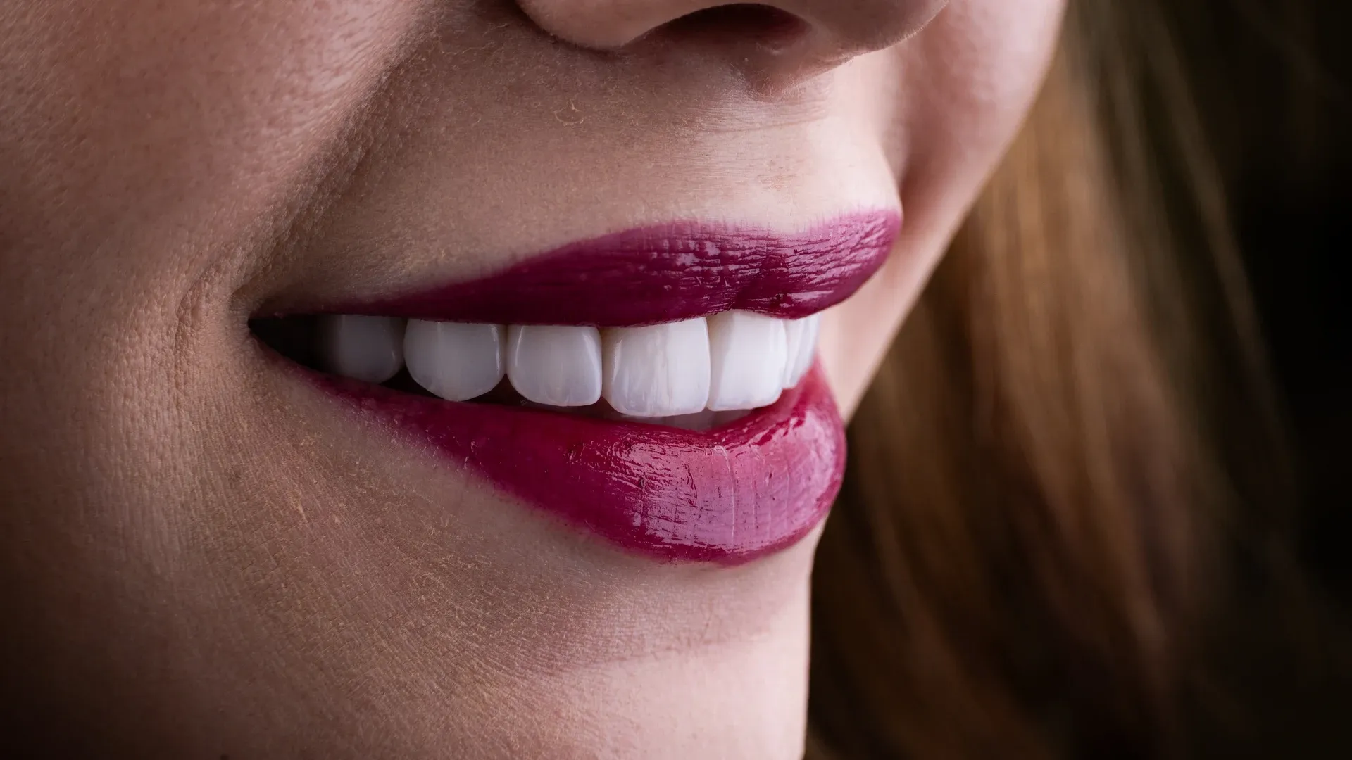 Close-up of a completed porcelain veneer smile at Vivid Smiles Dentistry in Parker, CO