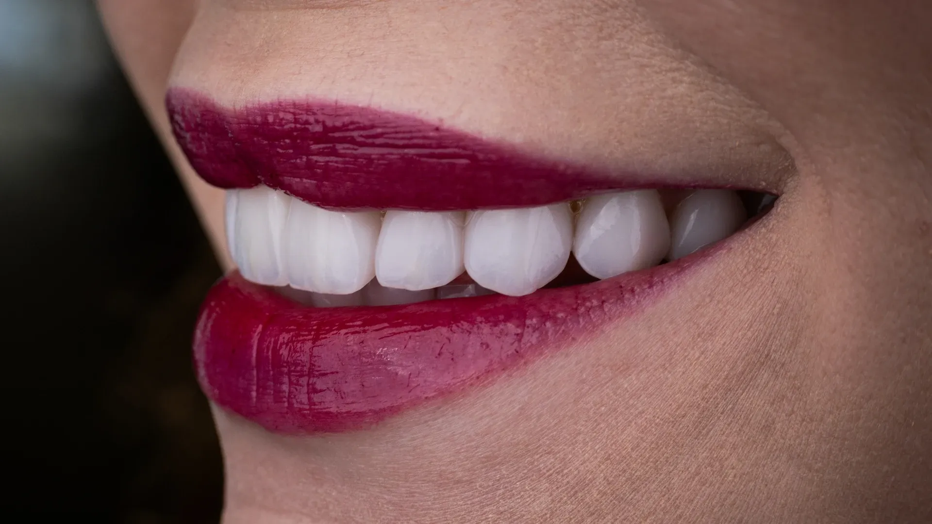 Close-up of a finished porcelain veneer smile, showing tooth shape and proportion against the lip line