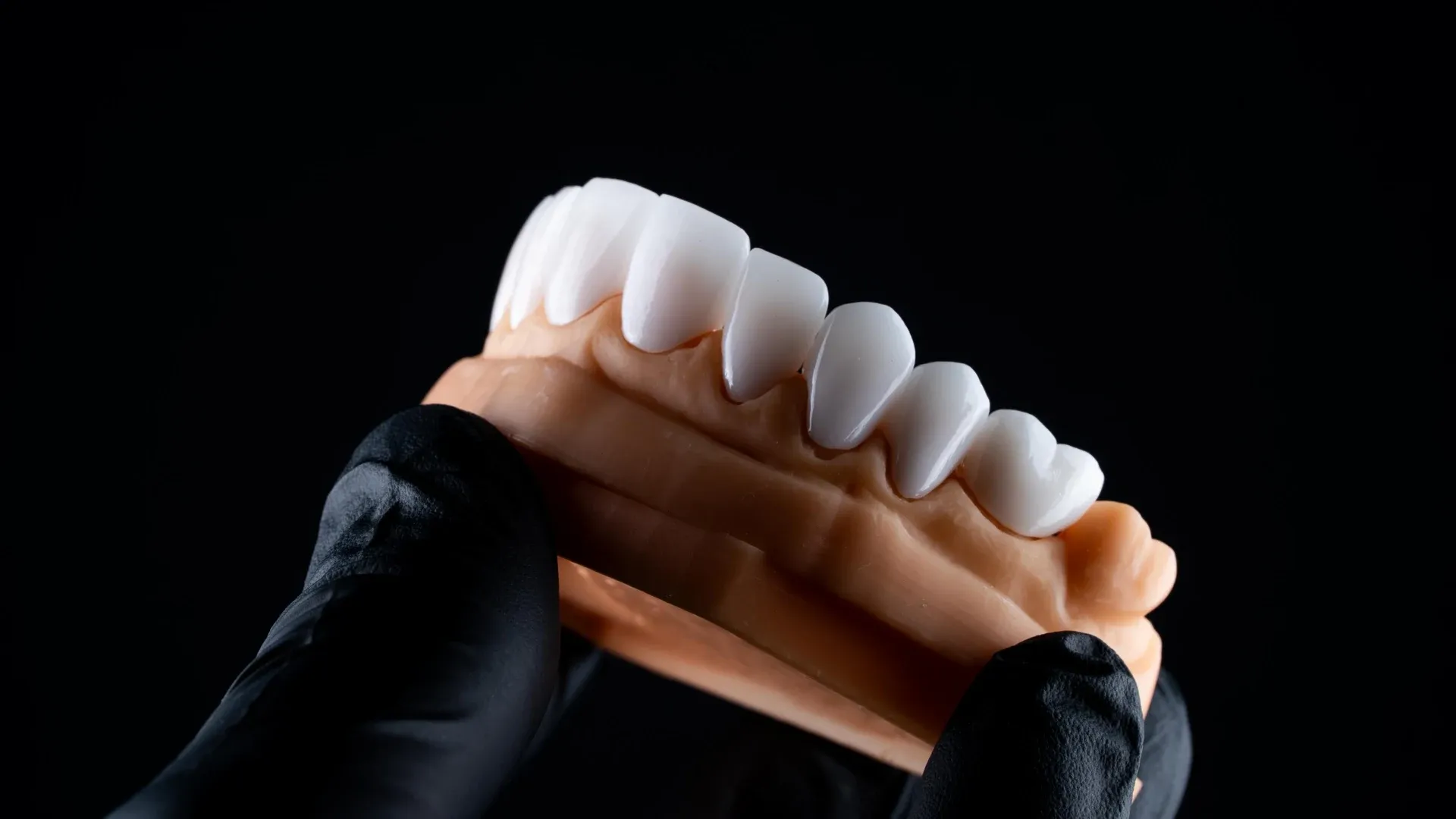 A set of porcelain veneer shells seated on a dental model, held in a gloved hand