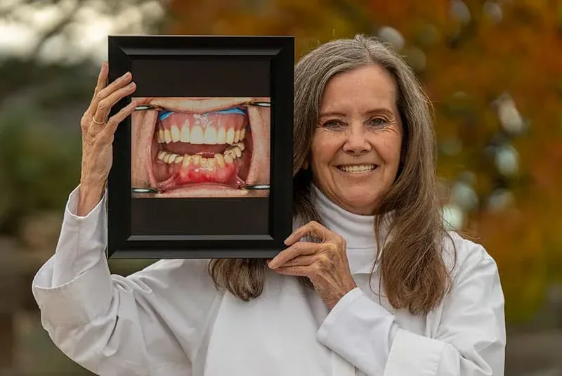 I Want All New Teeth - How Dental Implants Can Replace All Your Teeth