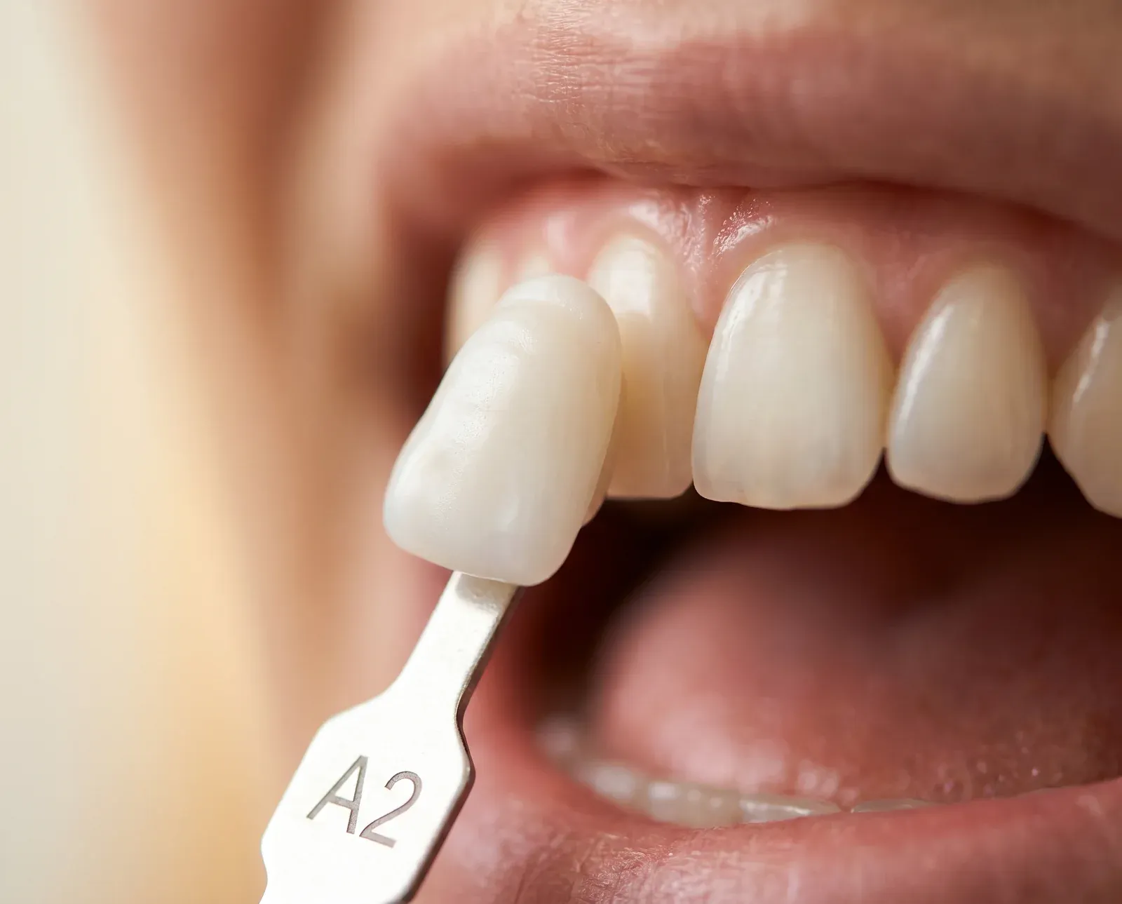 A porcelain veneer held up in front of a patient's teeth for shade matching in Parker, CO