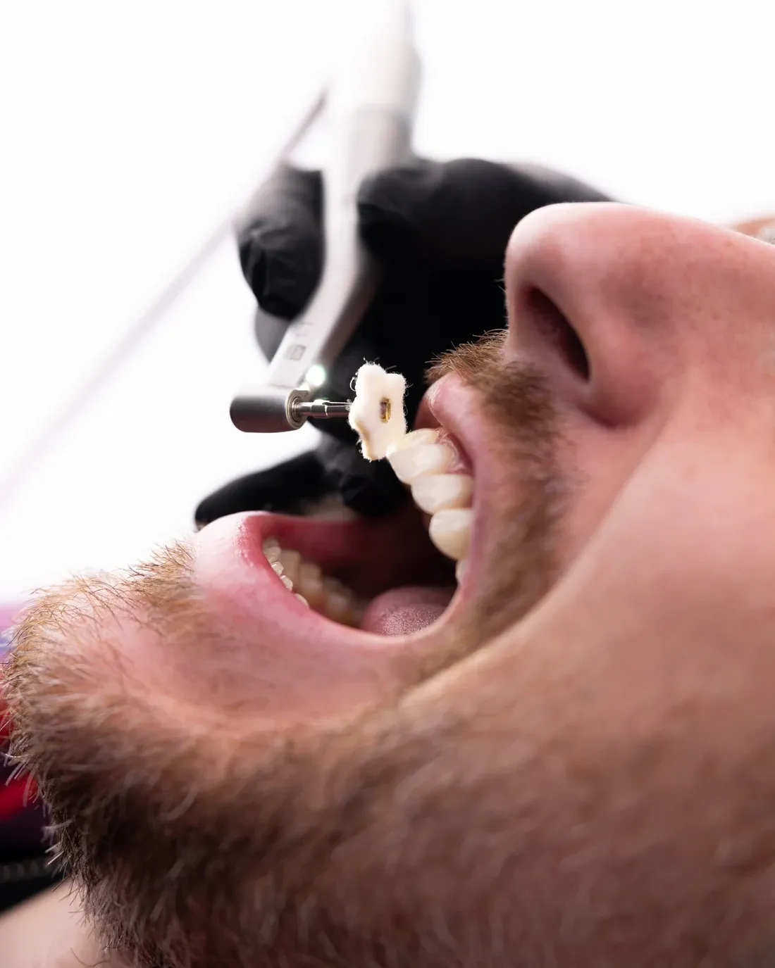 Hygienist polishing a patient's teeth during a cleaning