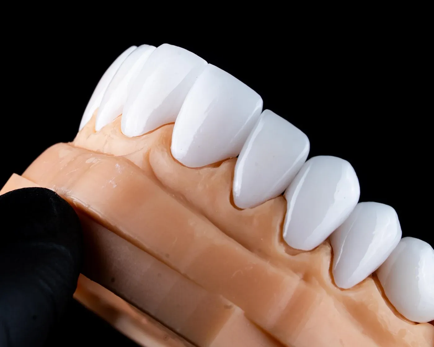 Close-up of an implant-supported restoration on a dental model