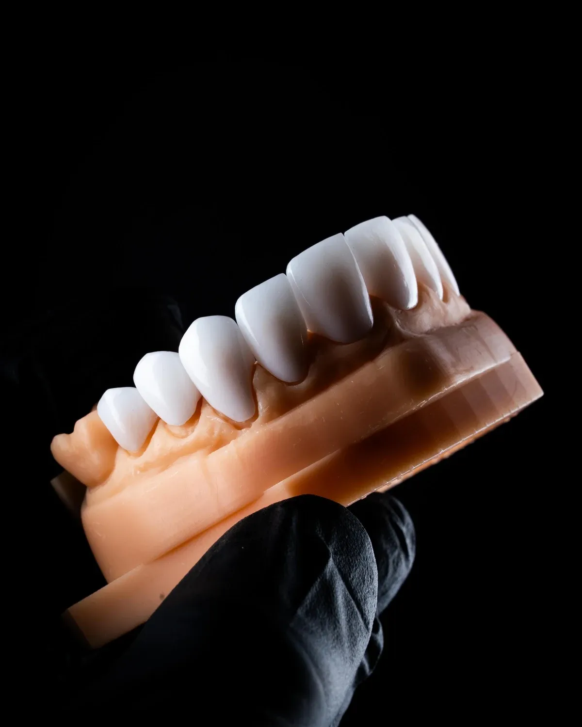An implant-supported restoration held on a dental model