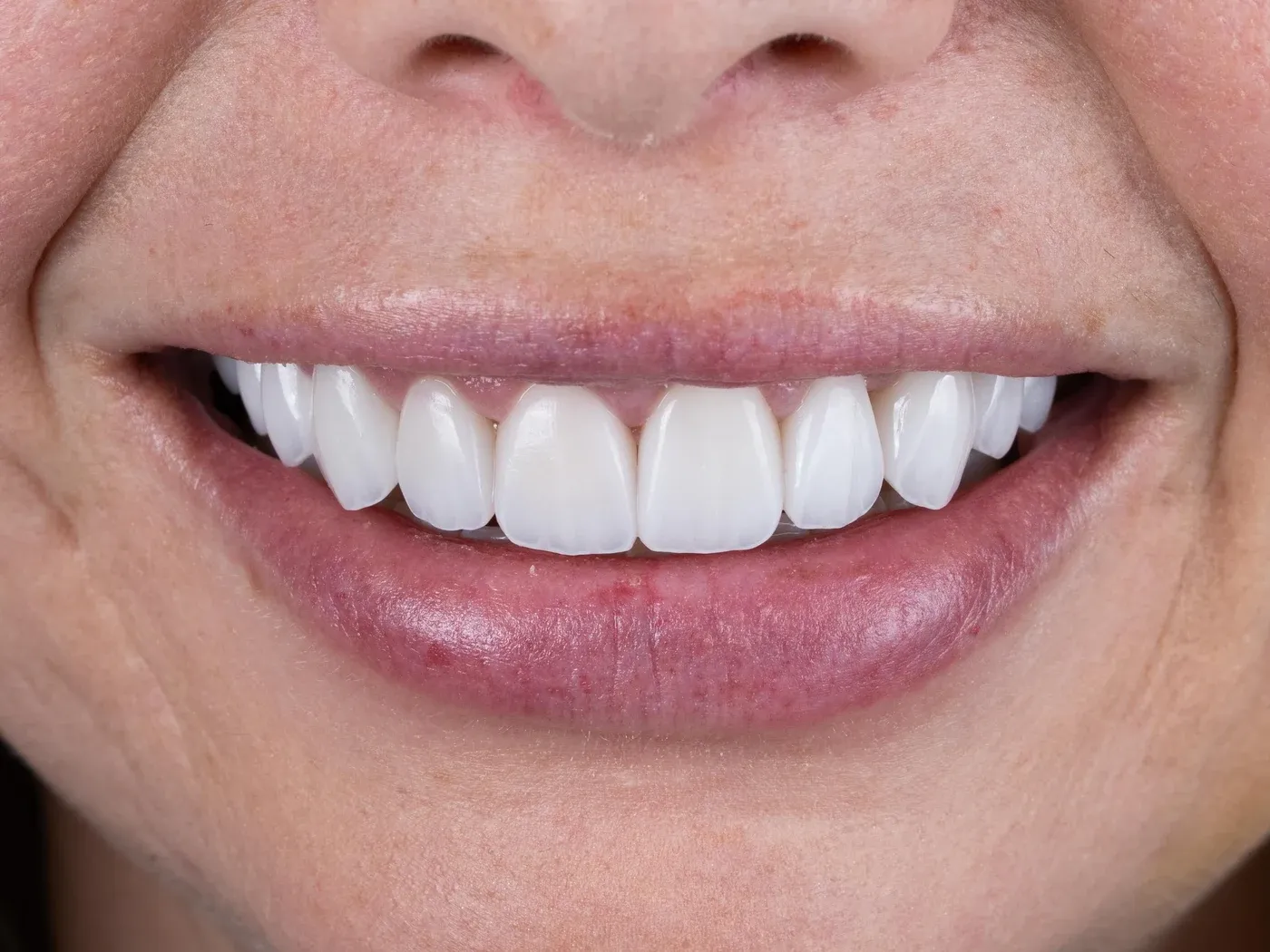 Front-on close-up of a smile showing the gumline