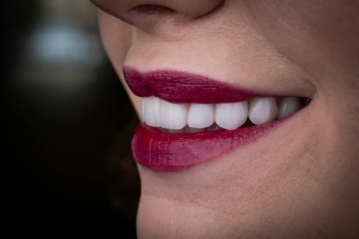 Close-up of a Vivid Smiles patient smiling