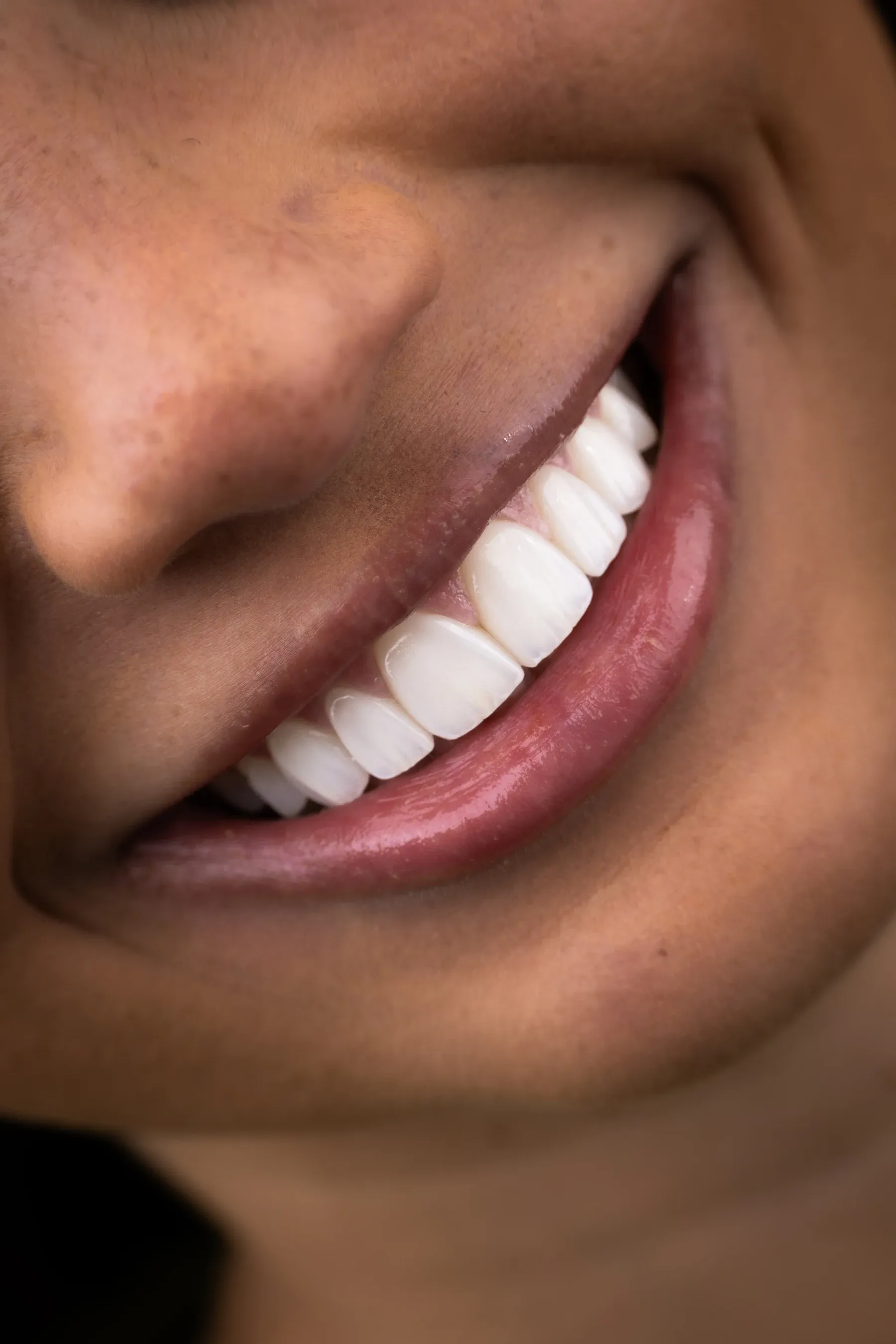 Close-up photograph of a Vivid Smiles patient smiling, three-quarter view