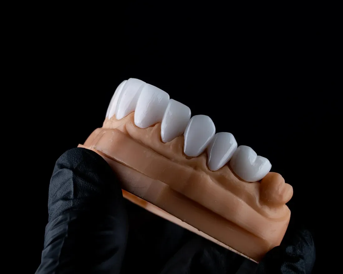 Porcelain veneer shells seated on a dental model at Vivid Smiles in Parker, CO