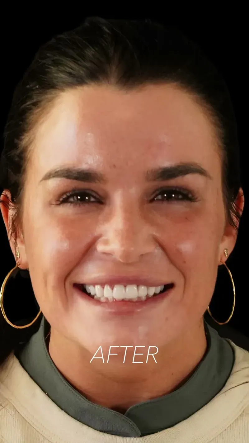 Porcelain veneers patient — after photo showing restored tooth length and balance
