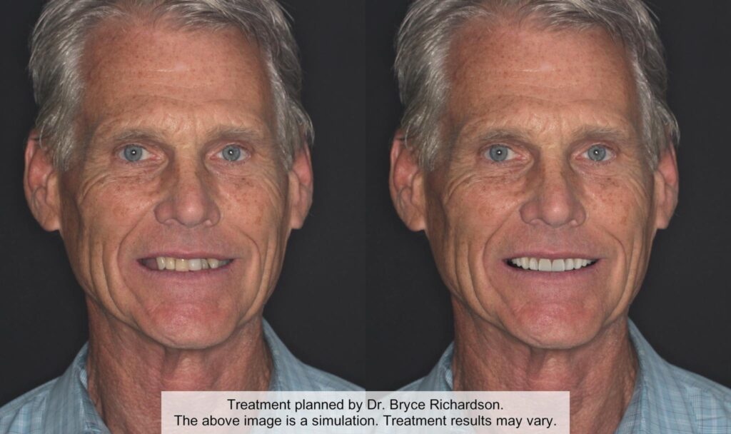 A side by side comparison of a man with a new set of teeth