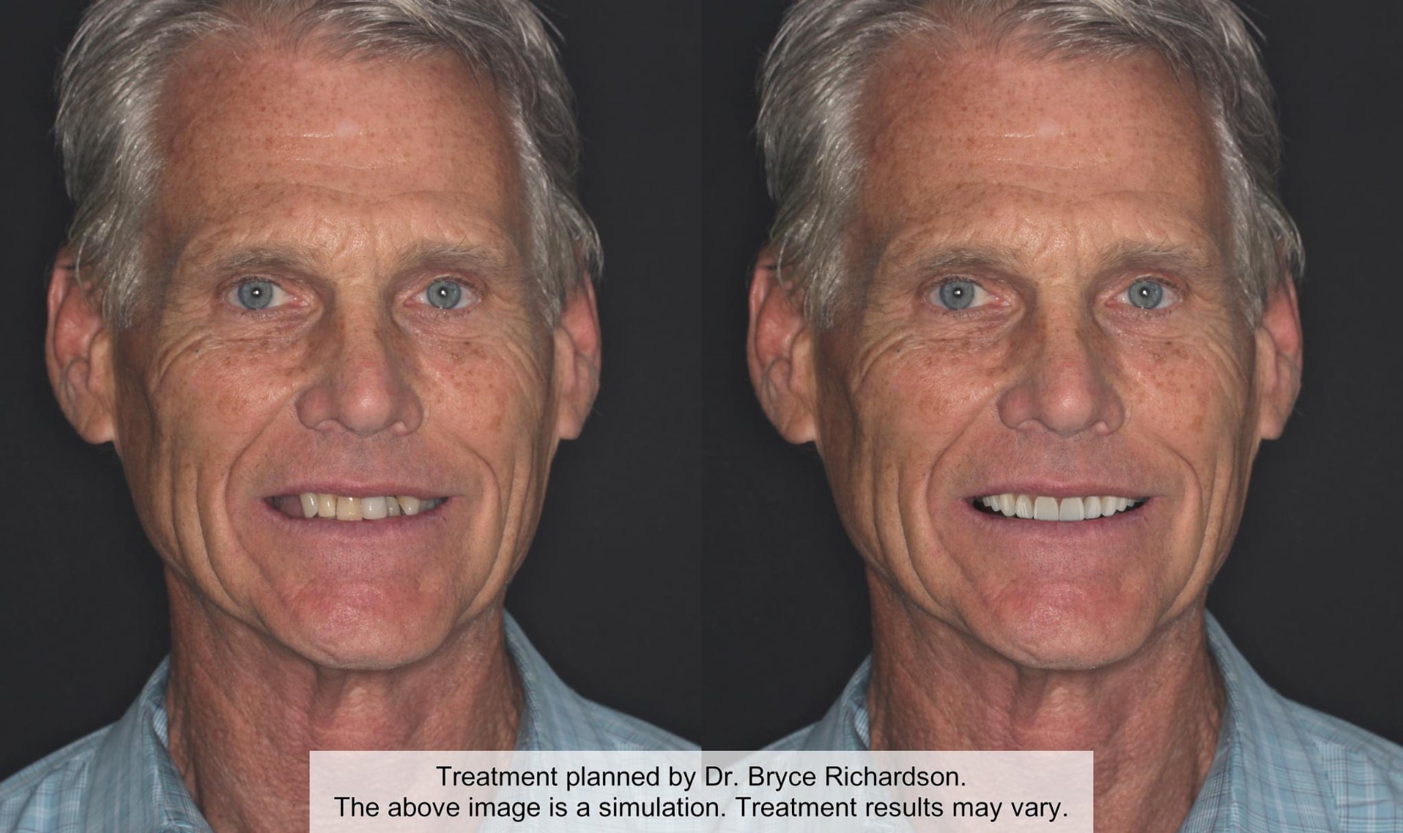 A side by side comparison of a man with a new set of teeth