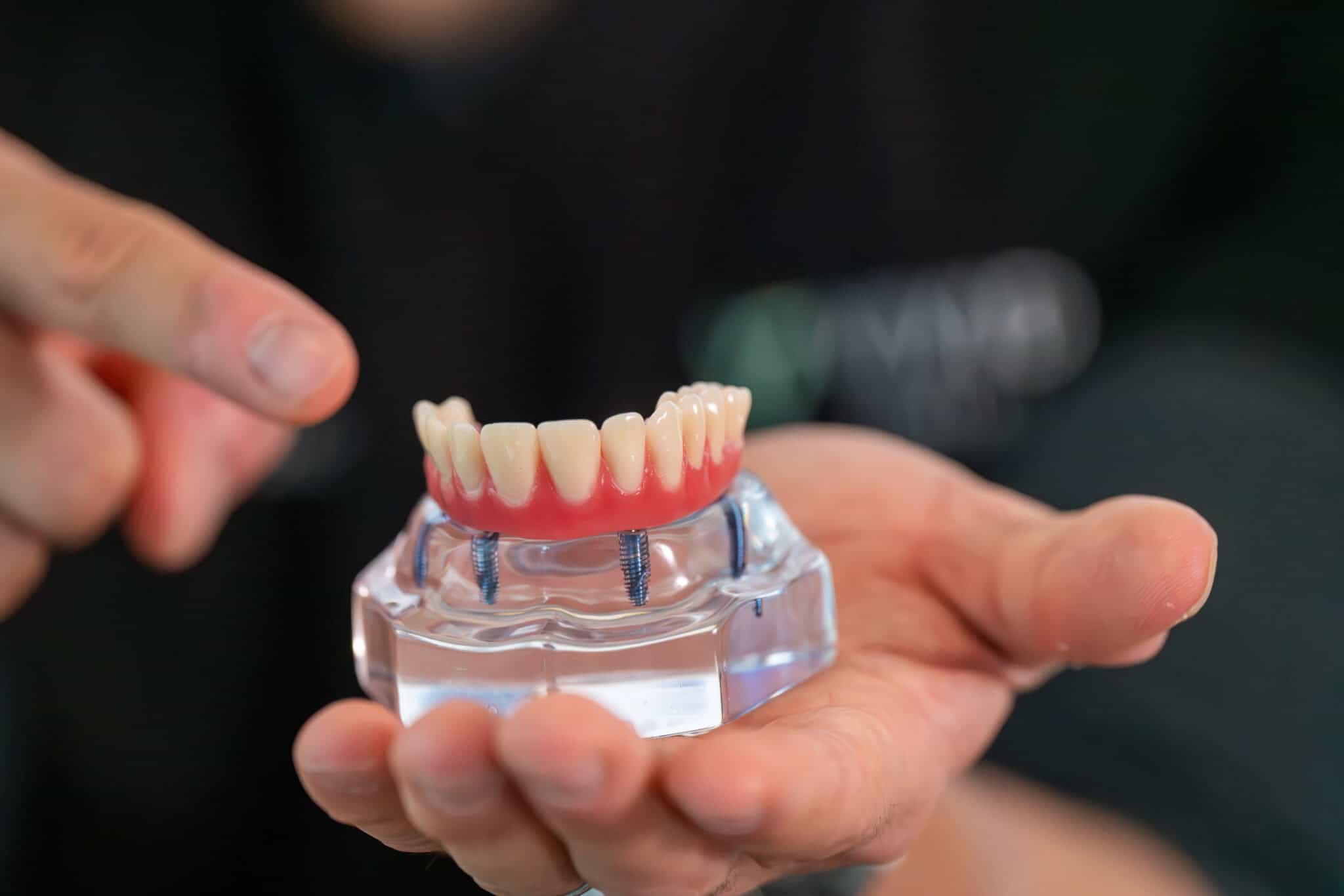 A hand holding a mock up of All-on-4 dental implant
