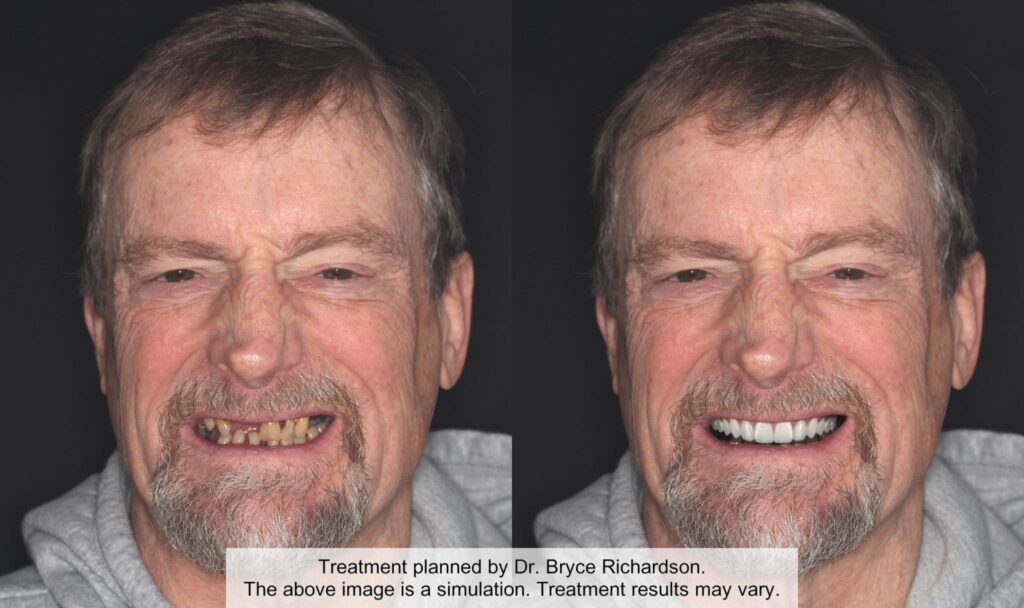 A side by side comparison of a older man with a new set of teeth
