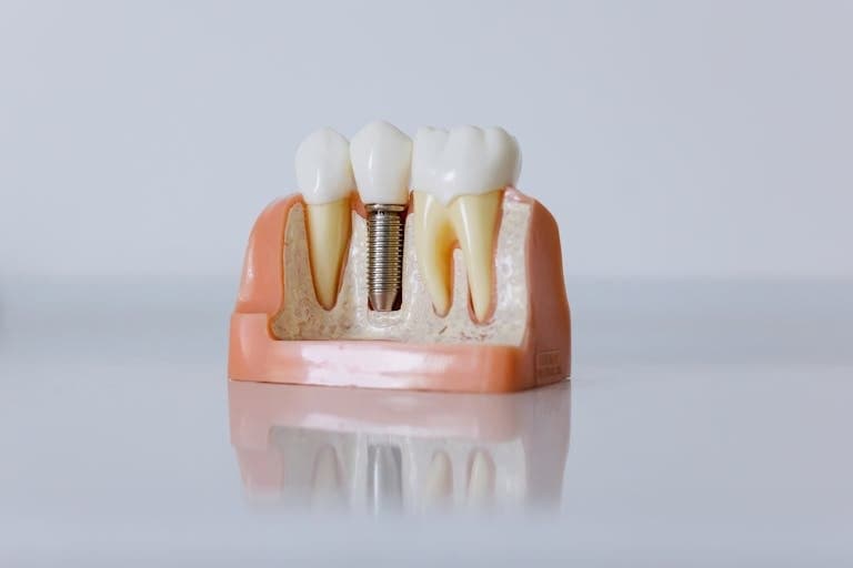 Dental Implant Mock Up