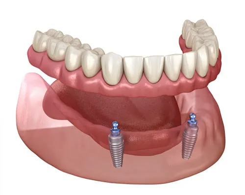 3D Render of a Implant Supported Denture
