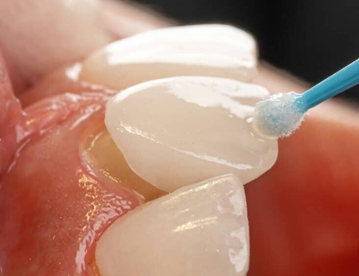 Showing a dental veneer being placed over a prepped tooth