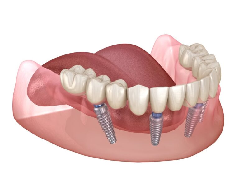 Lower arch of teeth connected to the jaw using implants