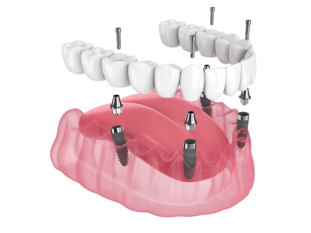 3D render of a All-on-4 dental implants