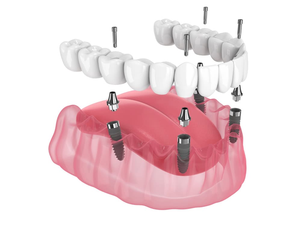 Implant Dentures using 4 implants