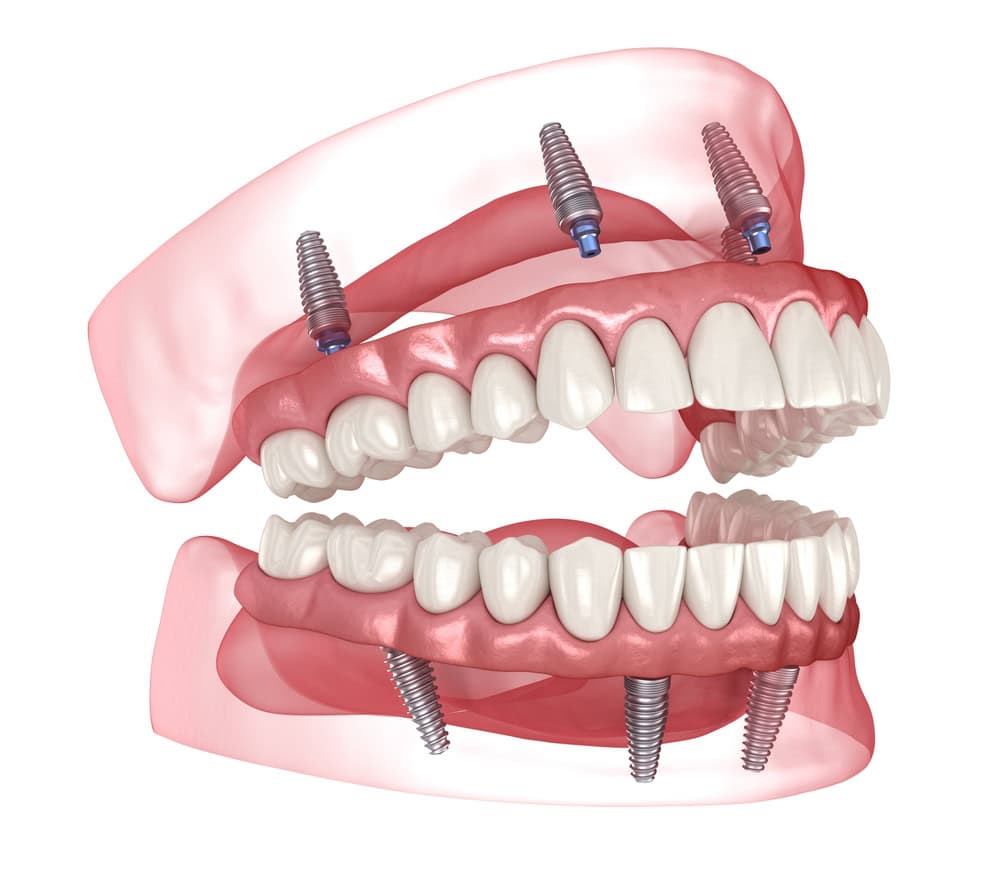 Full Upper and lower arch of teeth connected via implants