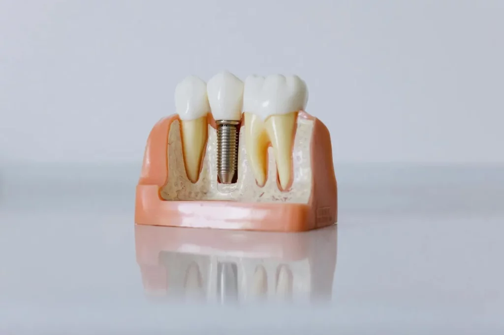 A dental implant mock-up for demonstrations