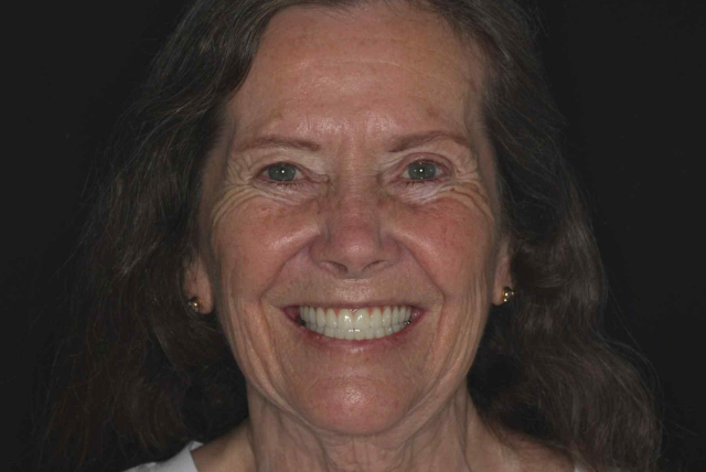 Patient J.N Shown With A Smile Facing The Camera After Dental Implants Were Placed At Vivid Smiles Dentistry - By Dr Bryce Richardson