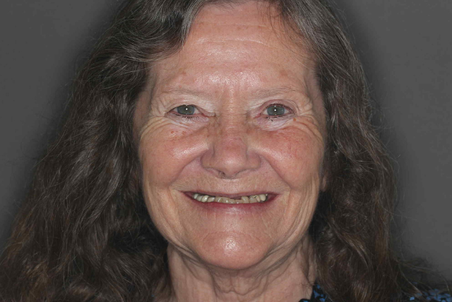 Patient J.N Shown With A Smile Facing The Camera Before Dental Implants Were Placed At Vivid Smiles Dentistry - By Dr Bryce Richardson