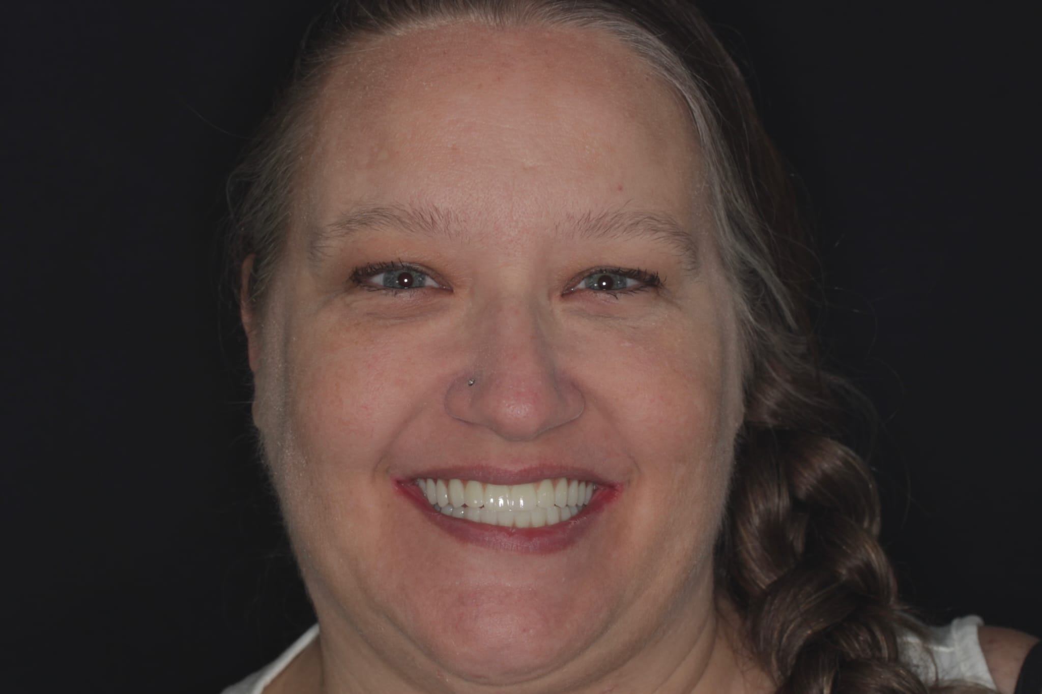 Patient C.A Shown With A Smile Facing The Camera After Veneers Were Placed At Vivid Smiles Dentistry - By Dr Bryce Richardson of Parker CO