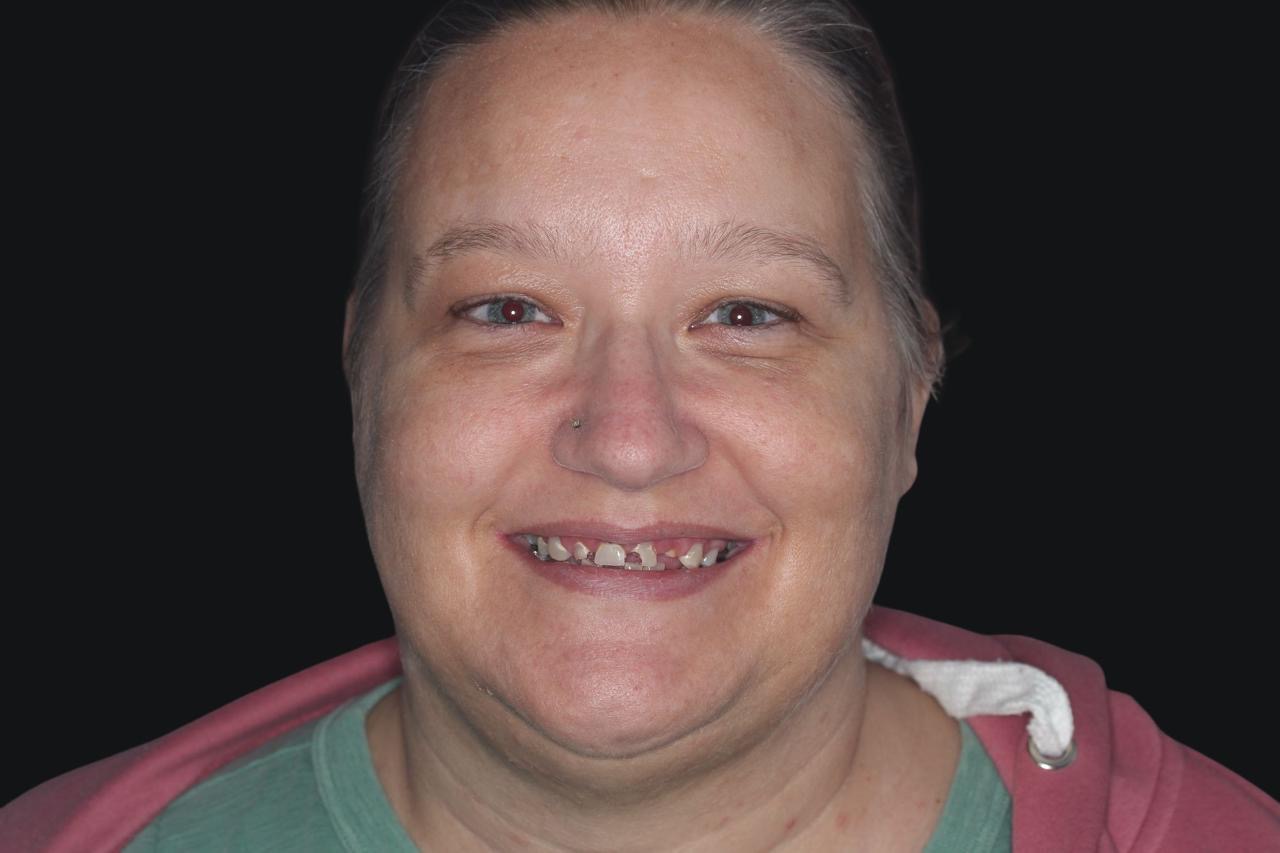 Patient C.A Shown With A Smile Facing The Camera Before Veneers Were Placed At Vivid Smiles Dentistry - By Dr Bryce Richardson of Parker CO