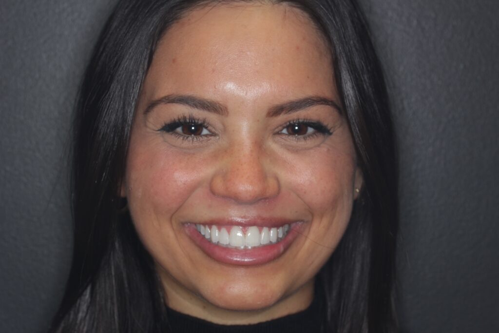 Dental Veneers by Dr. Bryce Richardson, A dentist in Parker CO at Vivid Smiles Dentistry