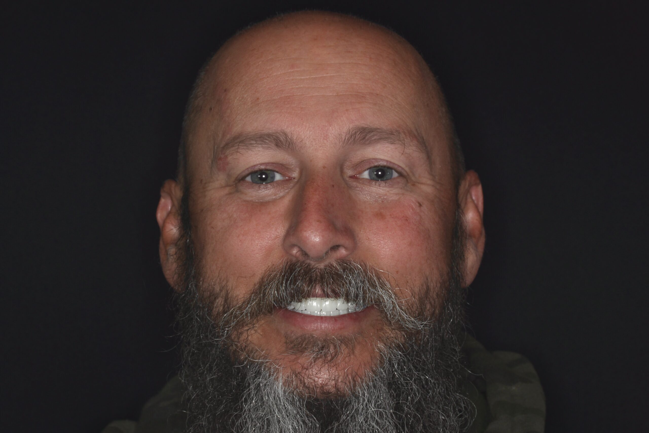 All On X All On X implants by Dr. Bryce Richardson, A dentist in Parker CO at Vivid Smiles Dentistry
